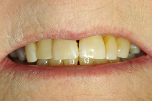 The image shows a close-up of an individual s mouth with teeth being cleaned by a dental hygienist, focusing on the person s smile and the cleaning process.