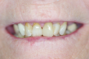 The image shows a person with a broad smile revealing teeth with visible yellowing and staining, particularly near the gumline.