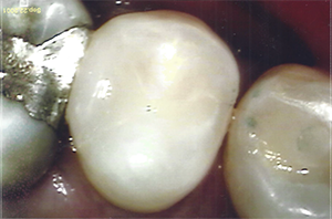 The image shows a close-up view of dental implants with visible screws, set against a blurred background that appears to be a human mouth.