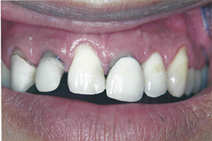 The image shows a close-up view of an individual s mouth with teeth that appear to be in need of dental care, specifically cleaning or possibly orthodontic treatment.