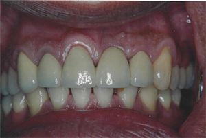 The image shows a close-up view of a person s mouth with teeth and gums visible, featuring a set of dentures or dental implants.