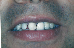 The image shows a close-up of a person s face with a focus on their teeth, which are white and appear to be well-maintained. They have a mustache and are smiling slightly.