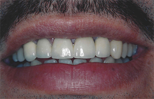 The image shows a close-up of a person s smiling mouth with teeth, revealing a wide smile, and there is no visible text within the image itself.