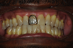 The image shows a close-up view of a person's mouth with yellowed teeth, some missing, and a visible gold tooth filling one gap.