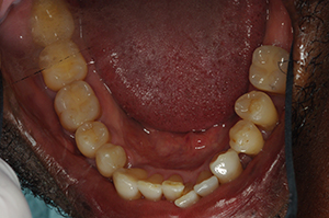 The image shows a close-up view of an open mouth with visible teeth and gums, revealing a condition that may require dental treatment.