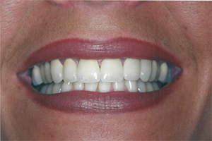 The image shows a person with a wide smile revealing straight white teeth, wearing lipstick, against a neutral background.
