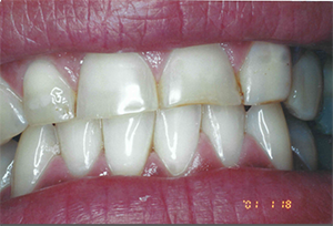 The image shows a close-up view of a person s teeth with a focus on an orthodontic treatment, such as braces or aligners, which are used for straightening teeth.