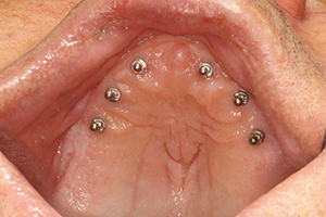 The image shows a close-up view of a person s mouth with multiple piercings visible on the lips, tongue, and cheeks.