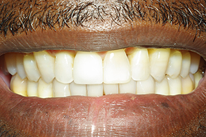 The image shows a close-up of a person's mouth with yellowed teeth and an open smile, with their facial hair and chin visible at the bottom.