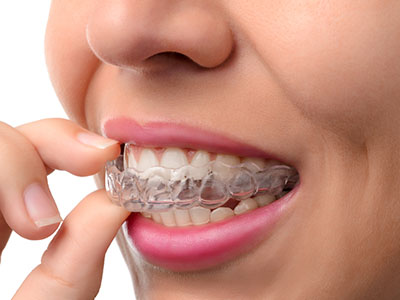 The image shows a person with a clear retainer on their teeth, holding it up to their mouth while looking at it.