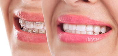 The image shows two close-up views of a person s smiling face with pink lipstick, highlighting their teeth and lips.