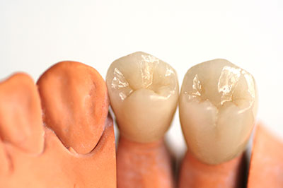 The image shows two teeth models with one set of teeth appearing yellowed and the other set appearing white, placed side by side against a plain background.