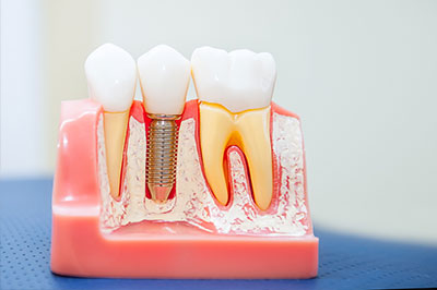 The image shows a model of human teeth with visible dental implants, screws, and a pink base, likely used for educational purposes or demonstrating dental procedures.