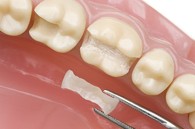 The image shows a close-up view of a dental implant being placed into a prepared tooth socket.