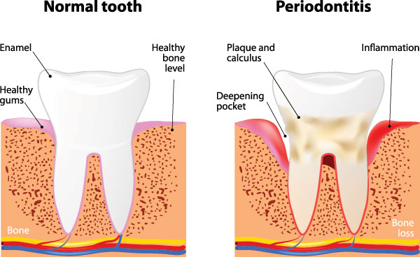 The image presents a detailed medical illustration showing different stages of tooth decay progression from normal to periodontitis, with annotations indicating the development of bone loss and cavity formation.