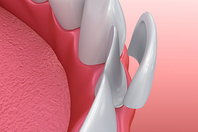 The image shows a close-up view of a dental implant fixture with a metallic screw protruding from a pink gum surface, set against a red background.