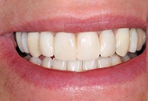 The image shows a close-up of a person s smile with straight white teeth and a pink lipstick on the lips.