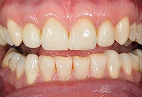 The image shows a close-up view of a person s teeth with some yellowing and staining, particularly noticeable on the front teeth, which are slightly crooked.