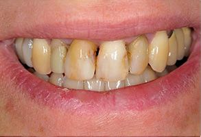The image shows a close-up of a person s teeth with visible yellowing, indicating possible dental issues such as staining or decay.