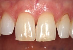 The image displays a close-up view of a person s teeth with visible signs of discoloration and possible dental issues, showcasing a need for dental care or treatment.